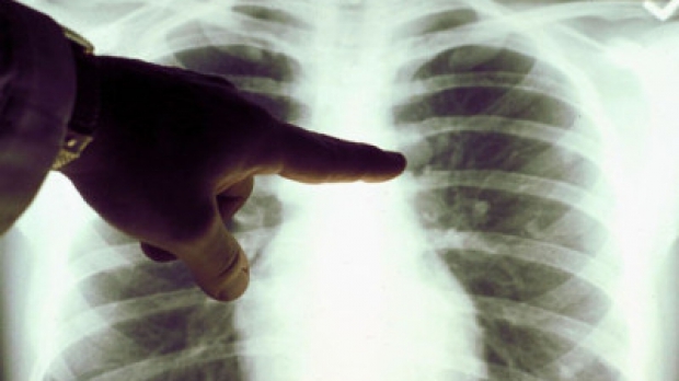 „O tuberculoză socialmente incurabilă” – Incurabila boală curabilă a României